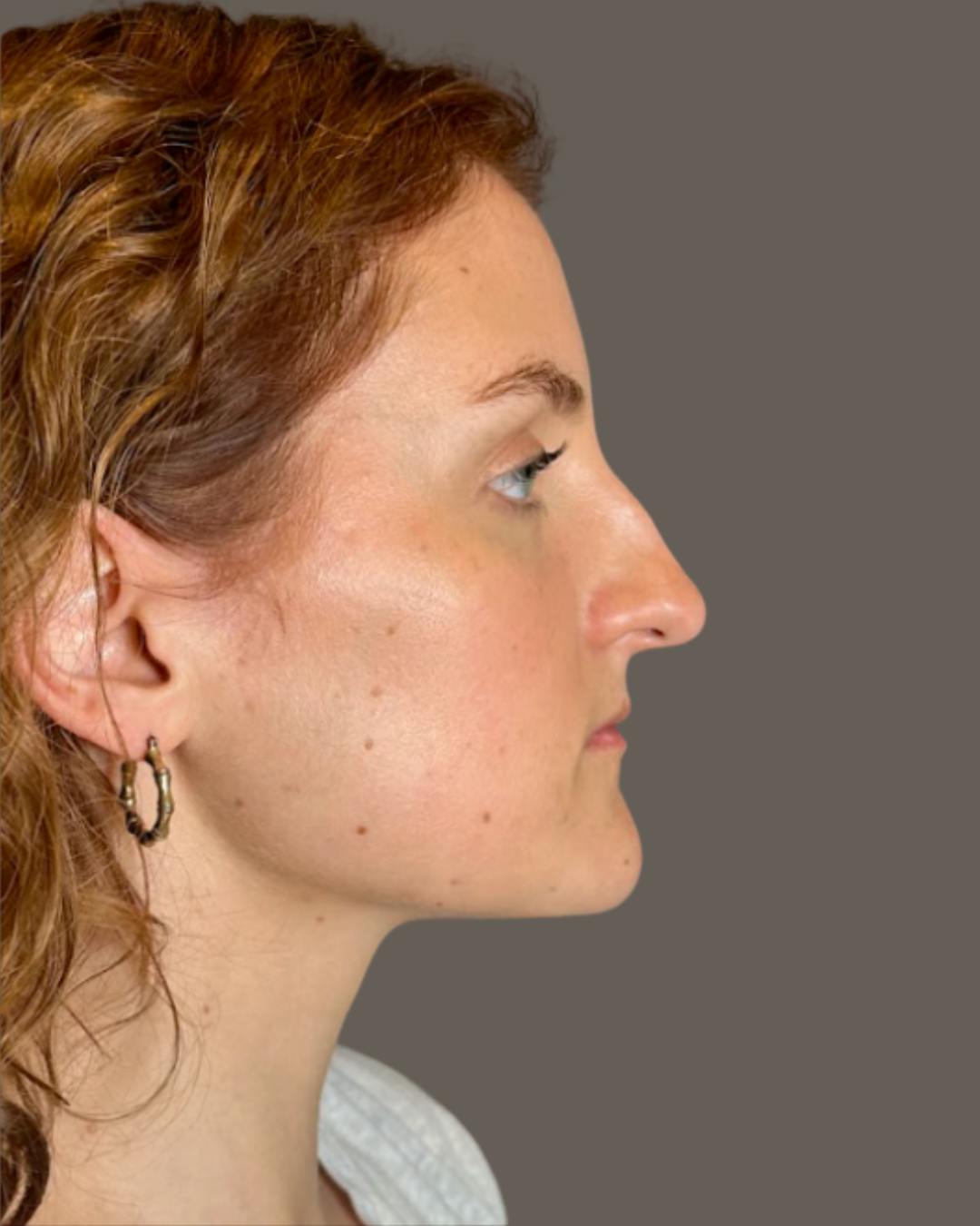 Rhinoplasty Before & After Gallery - Patient 352072 - Image 1