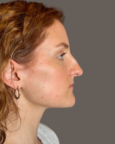 Rhinoplasty Before & After Gallery - Patient 352072 - Image 1