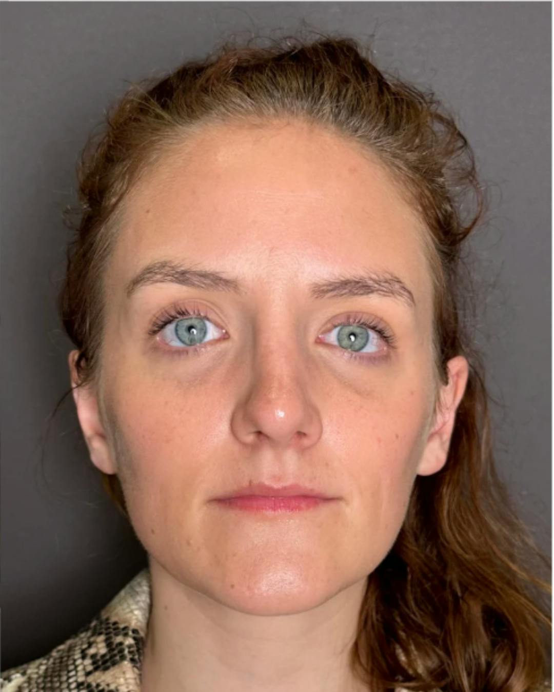 Rhinoplasty Before & After Gallery - Patient 352072 - Image 4