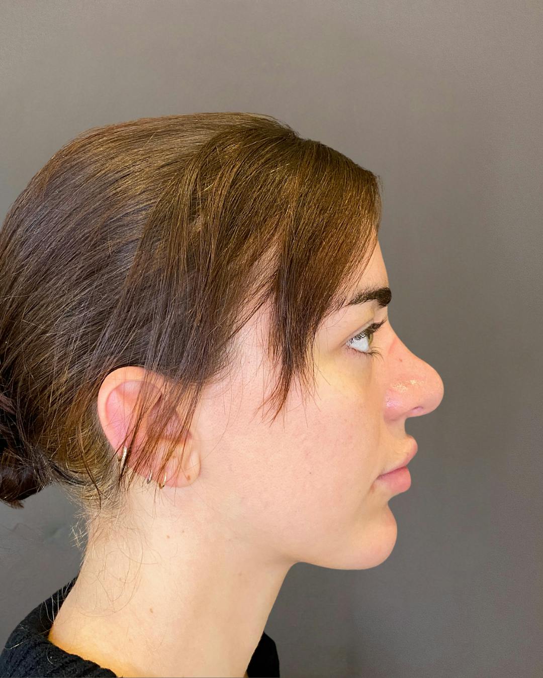 Rhinoplasty Before & After Gallery - Patient 191298628 - Image 1