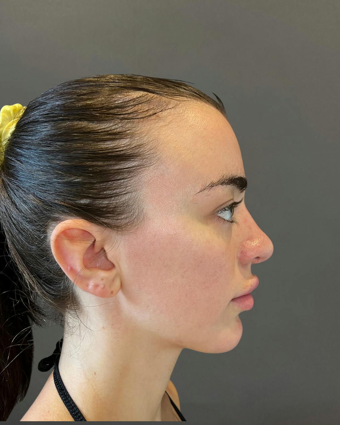 Rhinoplasty Before & After Gallery - Patient 191298628 - Image 2