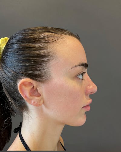 Rhinoplasty Before & After Gallery - Patient 191298628 - Image 2