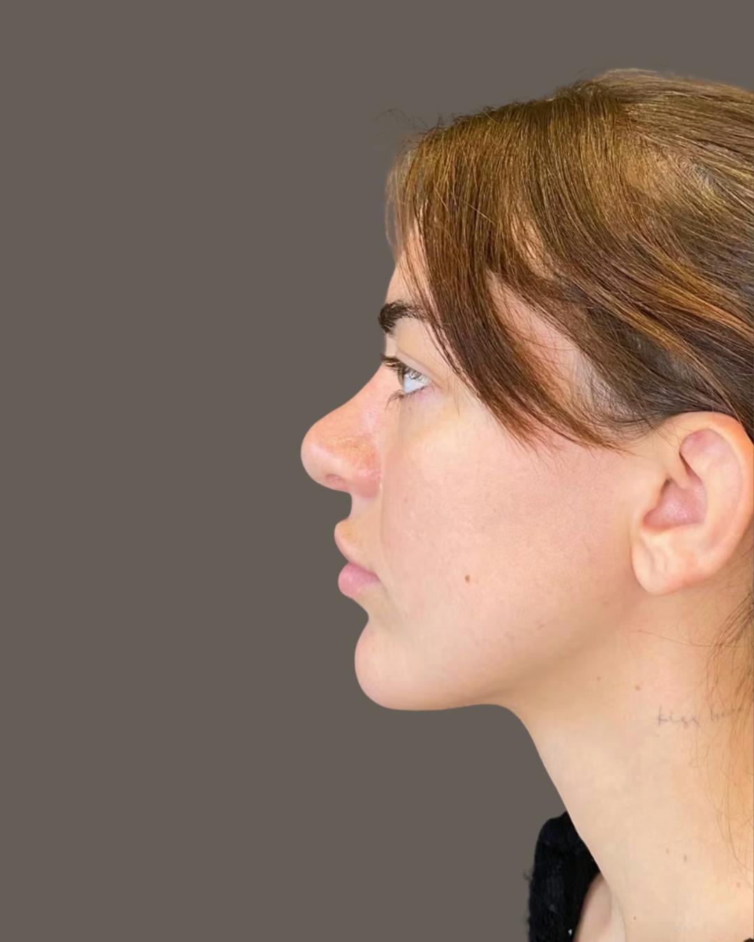 Rhinoplasty Before & After Gallery - Patient 191298628 - Image 5