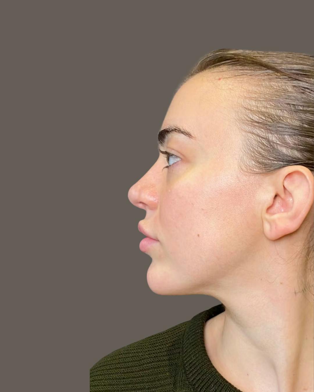Rhinoplasty Before & After Gallery - Patient 191298628 - Image 6