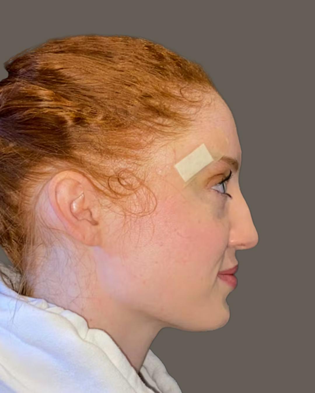 Rhinoplasty Before & After Gallery - Patient 348332 - Image 1