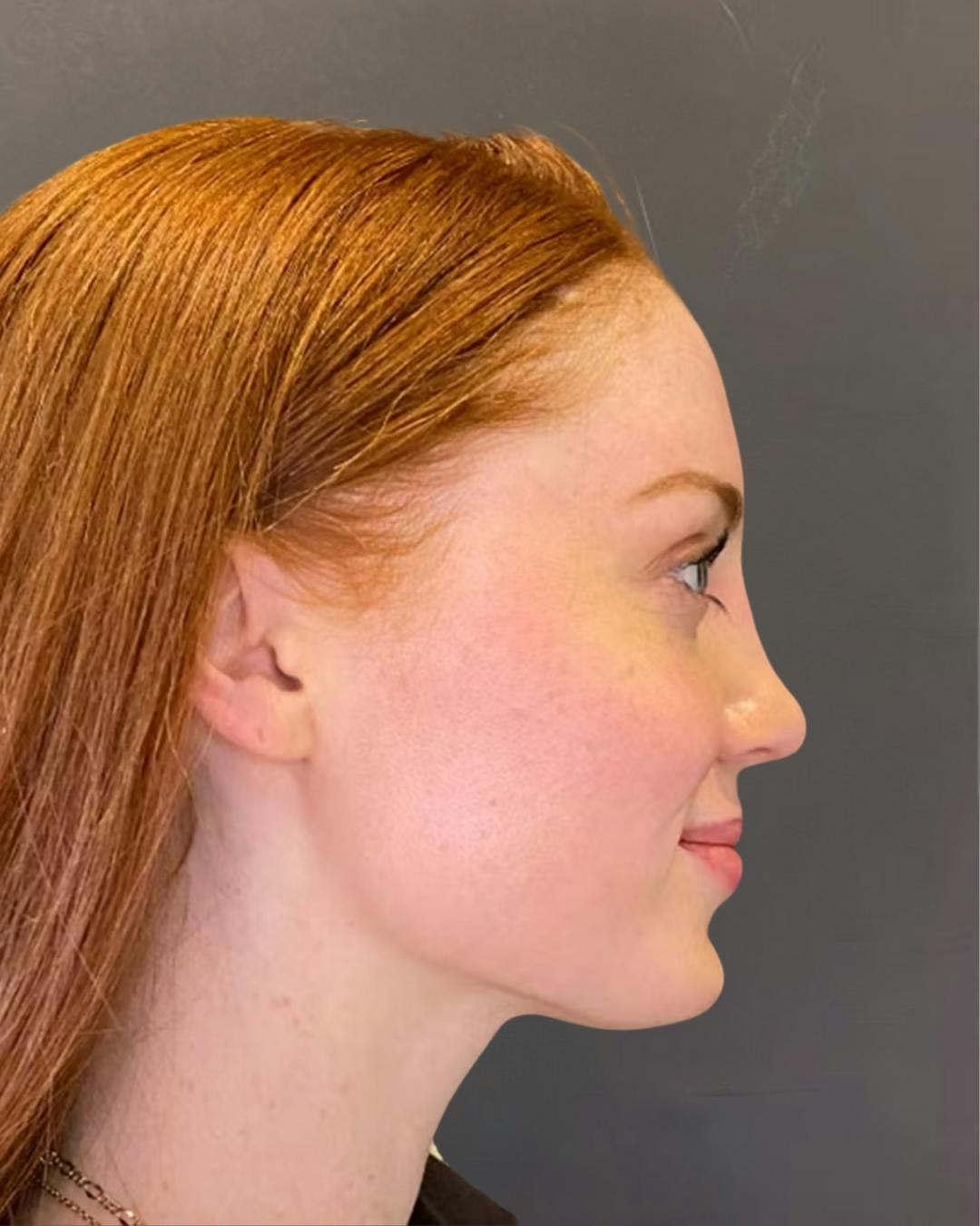 Rhinoplasty Before & After Gallery - Patient 348332 - Image 2