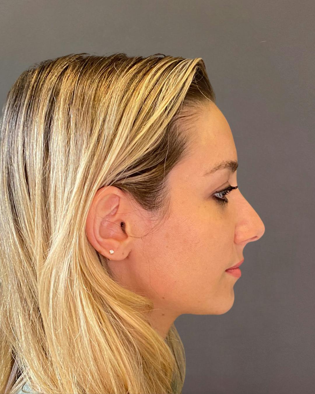 Rhinoplasty Before & After Gallery - Patient 263581 - Image 1