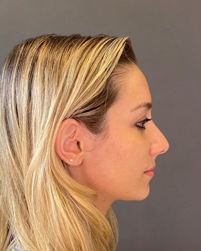 Rhinoplasty Before & After Gallery - Patient 263581 - Image 1