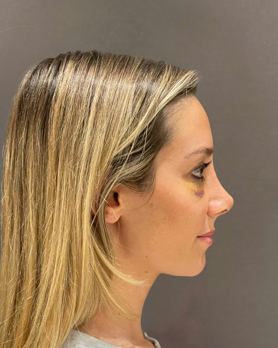 Rhinoplasty Before & After Gallery - Patient 263581 - Image 2