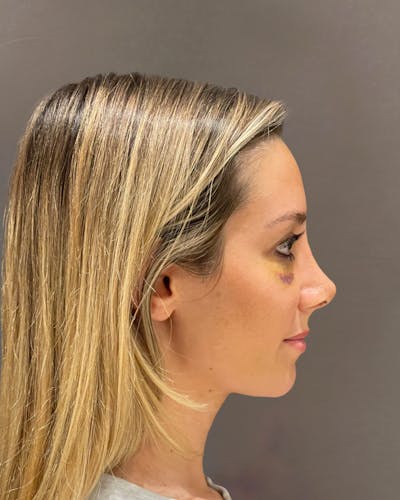 Rhinoplasty Before & After Gallery - Patient 263581 - Image 2