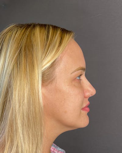 Rhinoplasty Before & After Gallery - Patient 191294109 - Image 1