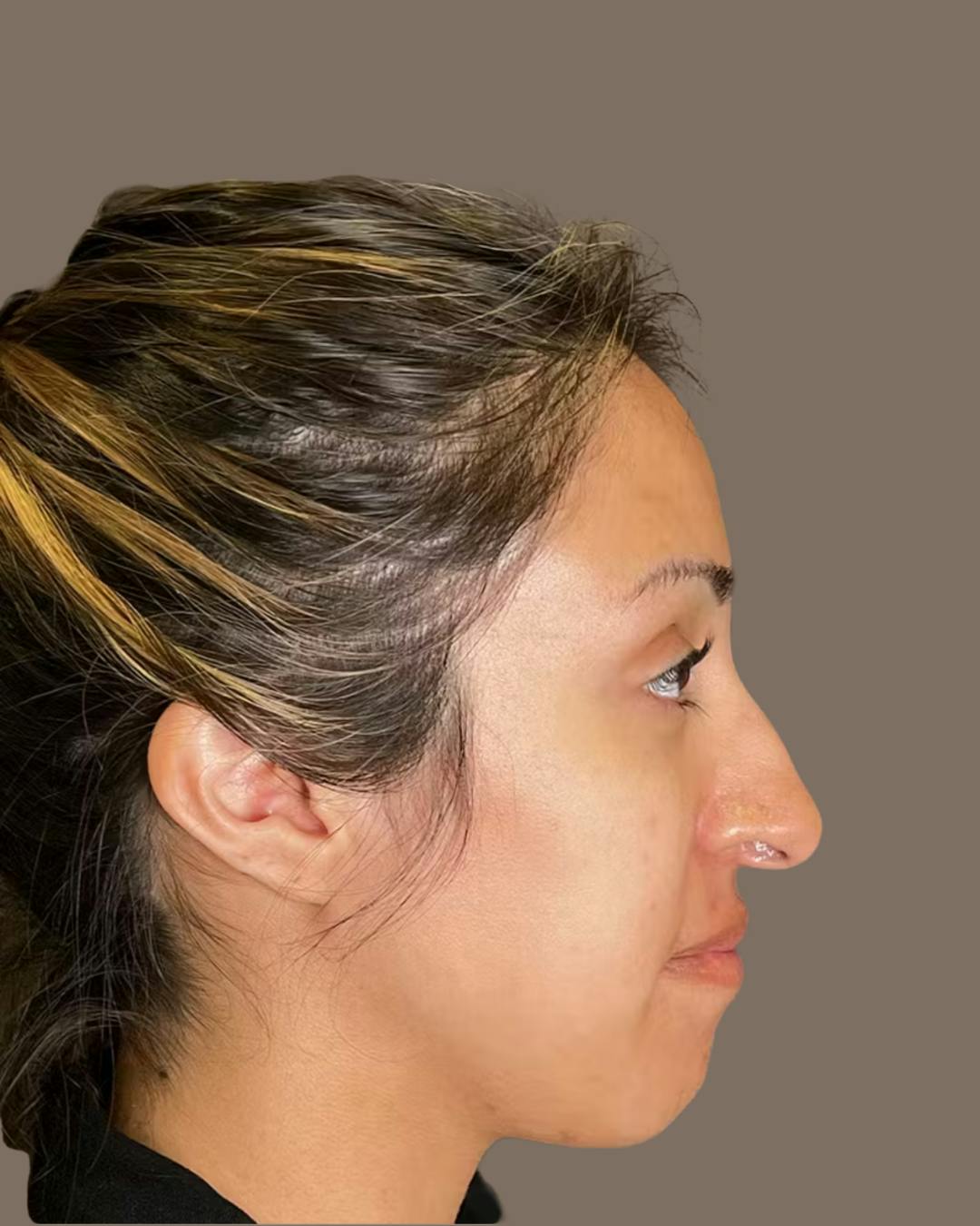 Rhinoplasty Before & After Gallery - Patient 900363 - Image 1