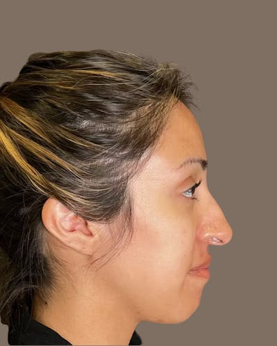 Rhinoplasty Before & After Gallery - Patient 900363 - Image 1