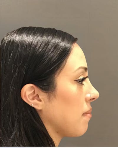 Rhinoplasty Before & After Gallery - Patient 900363 - Image 2