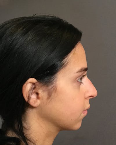 Rhinoplasty Before & After Gallery - Patient 265222 - Image 1