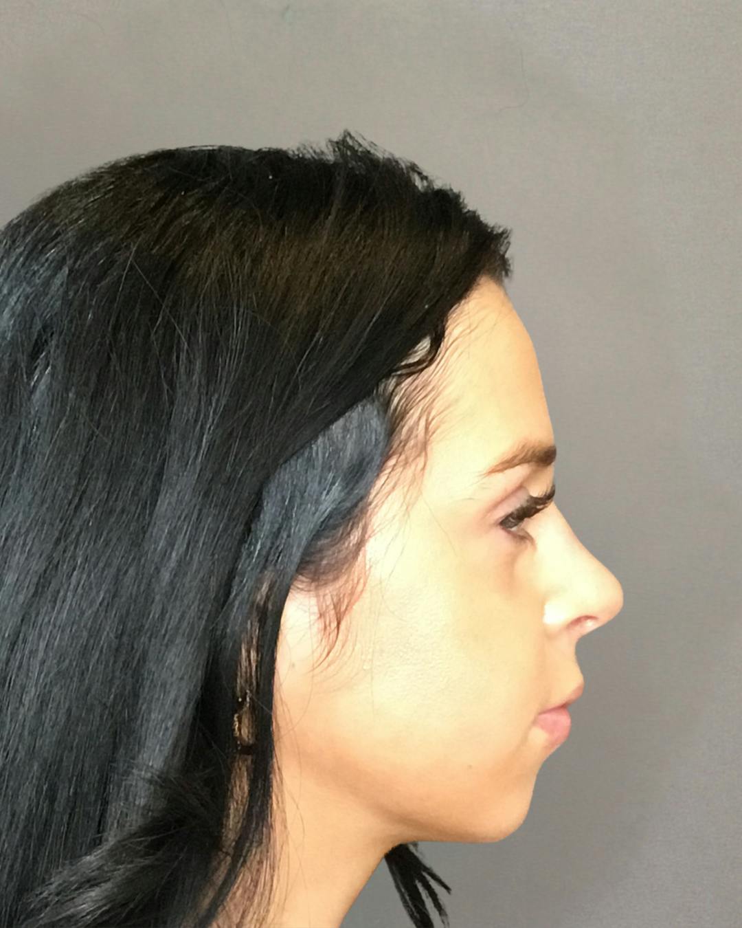 Rhinoplasty Before & After Gallery - Patient 265222 - Image 2