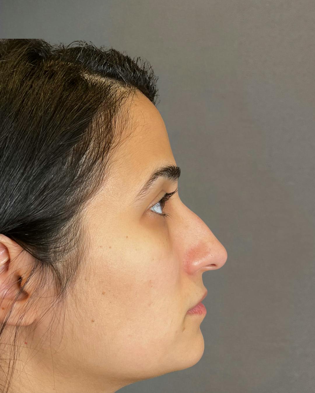 Rhinoplasty Before & After Gallery - Patient 191299778 - Image 1