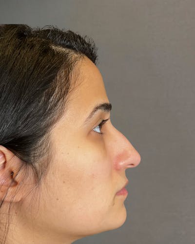 Rhinoplasty Before & After Gallery - Patient 191299778 - Image 1