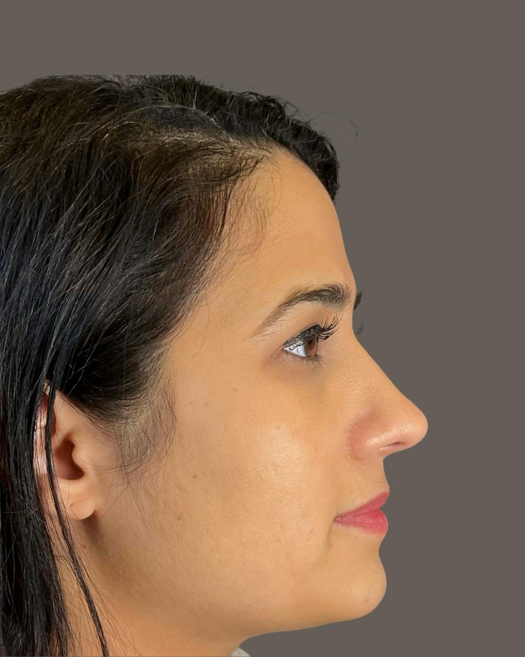 Rhinoplasty Before & After Gallery - Patient 191299778 - Image 2