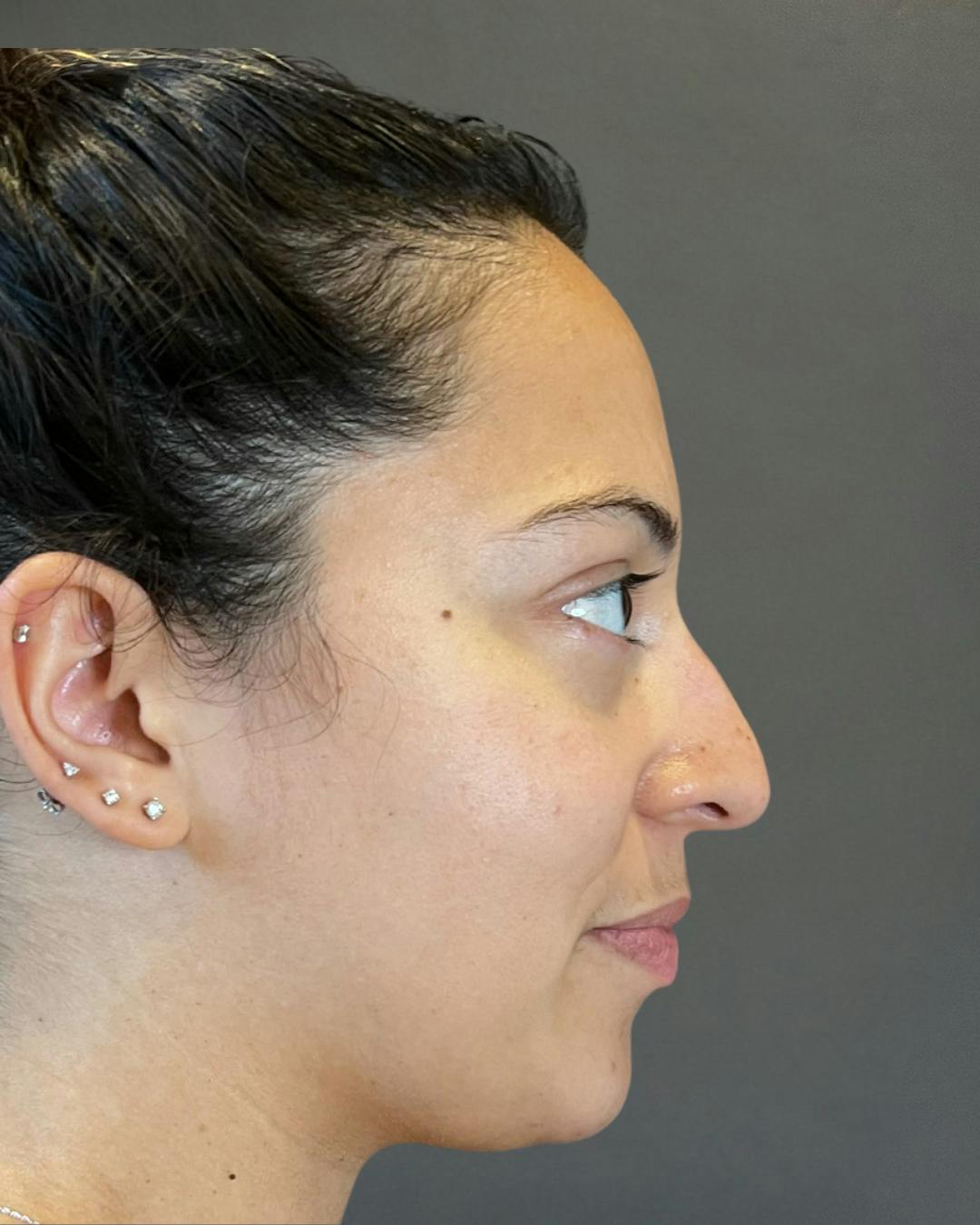 Rhinoplasty Before & After Gallery - Patient 366724 - Image 1