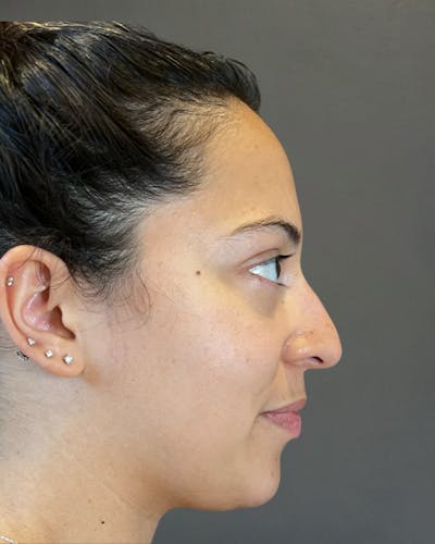Rhinoplasty Before & After Gallery - Patient 366724 - Image 1