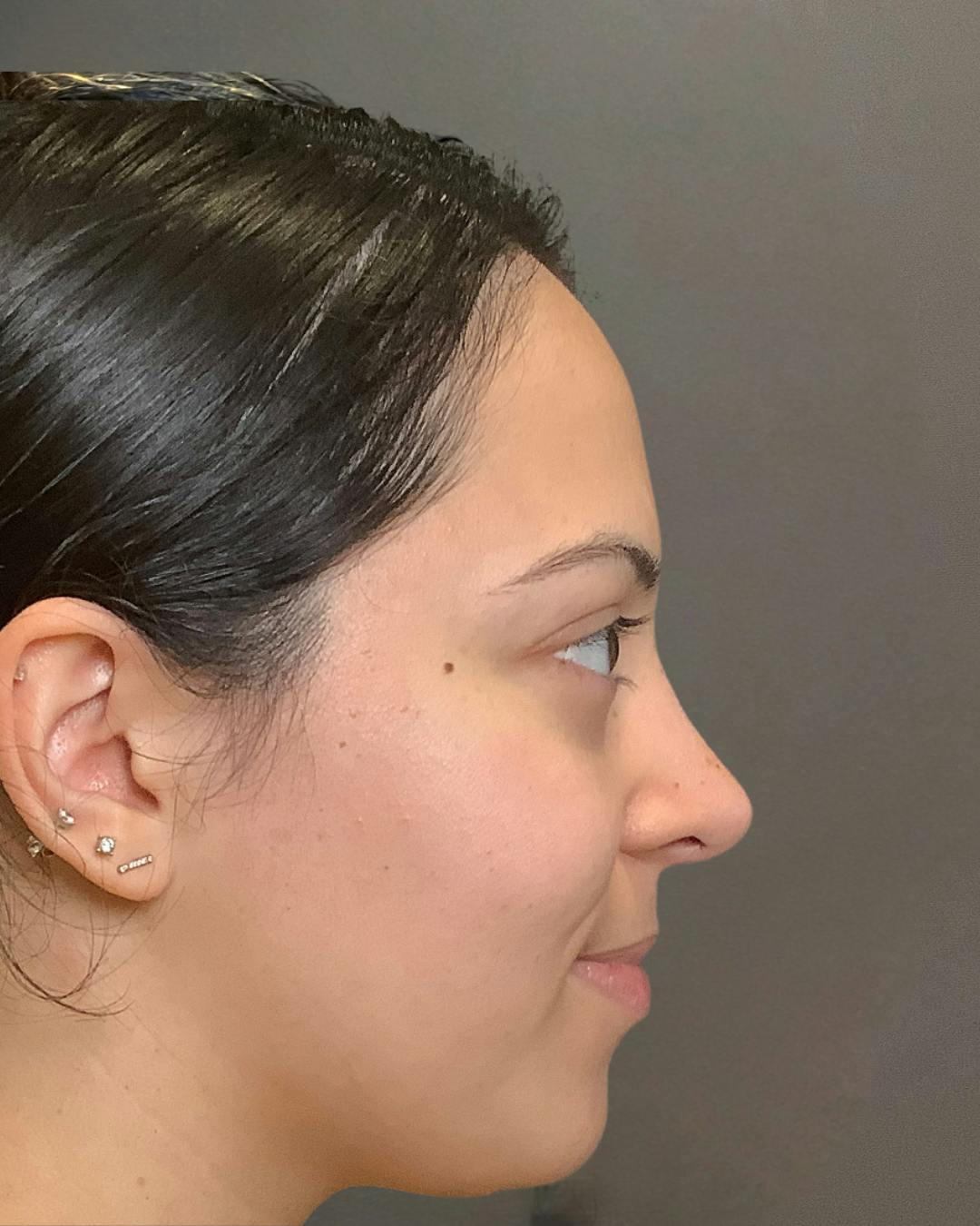 Rhinoplasty Before & After Gallery - Patient 366724 - Image 2