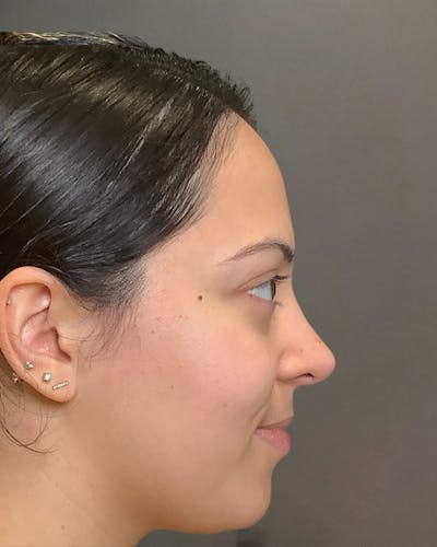 Rhinoplasty Before & After Gallery - Patient 366724 - Image 2