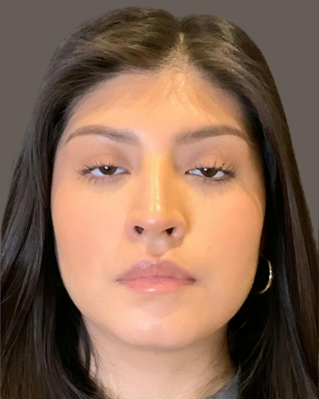 Rhinoplasty Before & After Gallery - Patient 127898 - Image 5