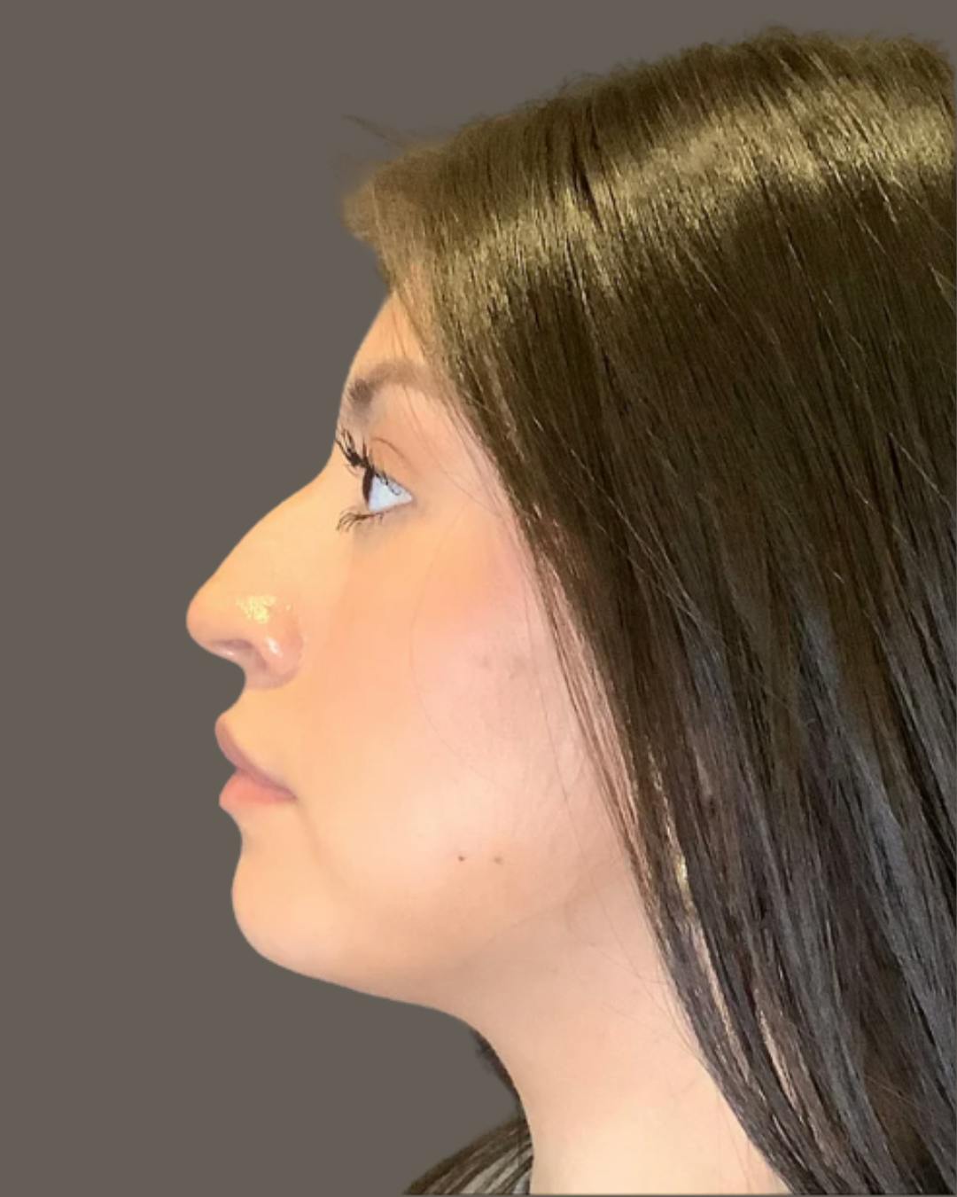 Rhinoplasty Before & After Gallery - Patient 127898 - Image 7