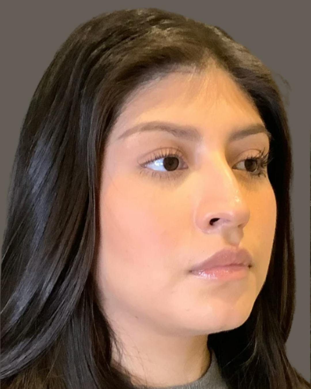 Rhinoplasty Before & After Gallery - Patient 127898 - Image 3
