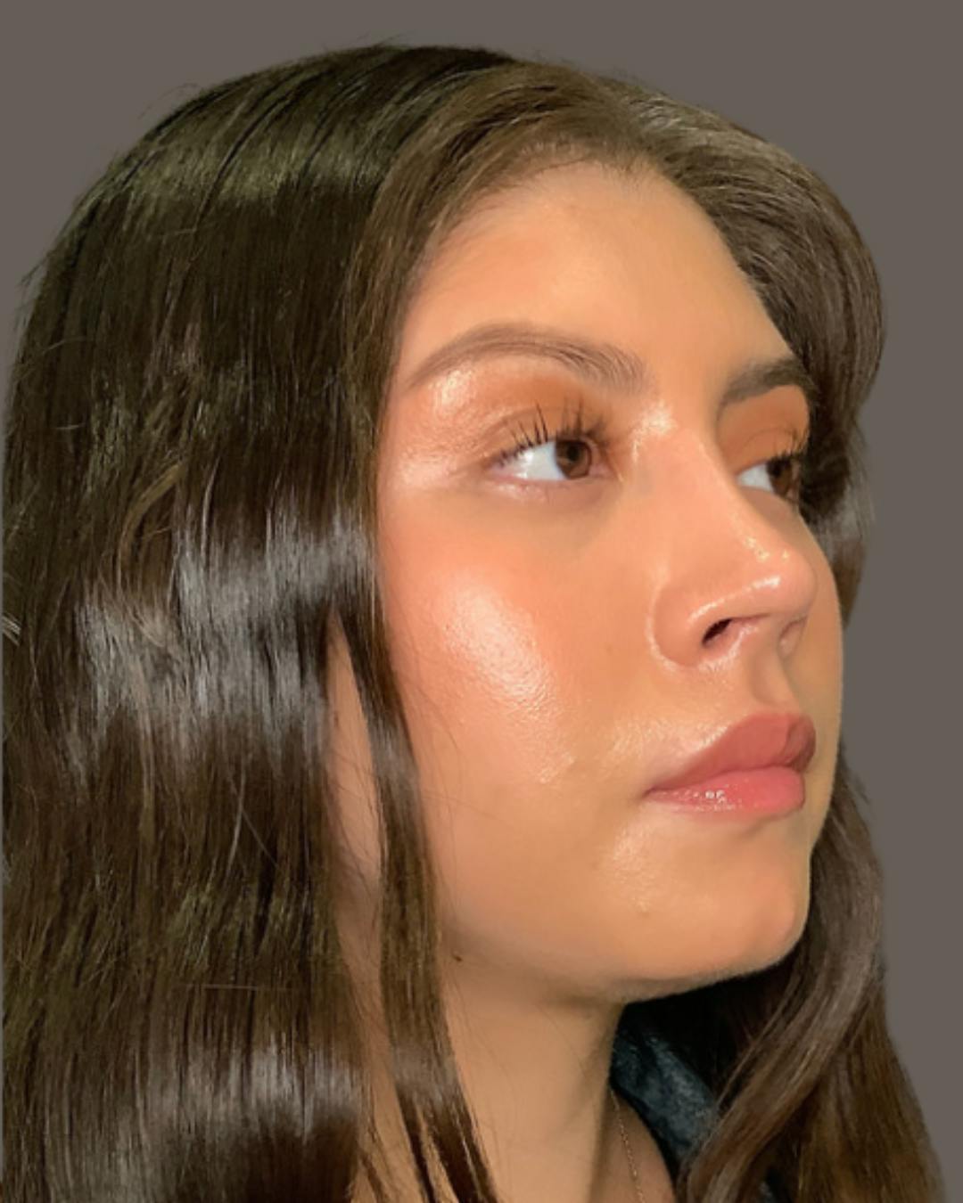 Rhinoplasty Before & After Gallery - Patient 127898 - Image 4
