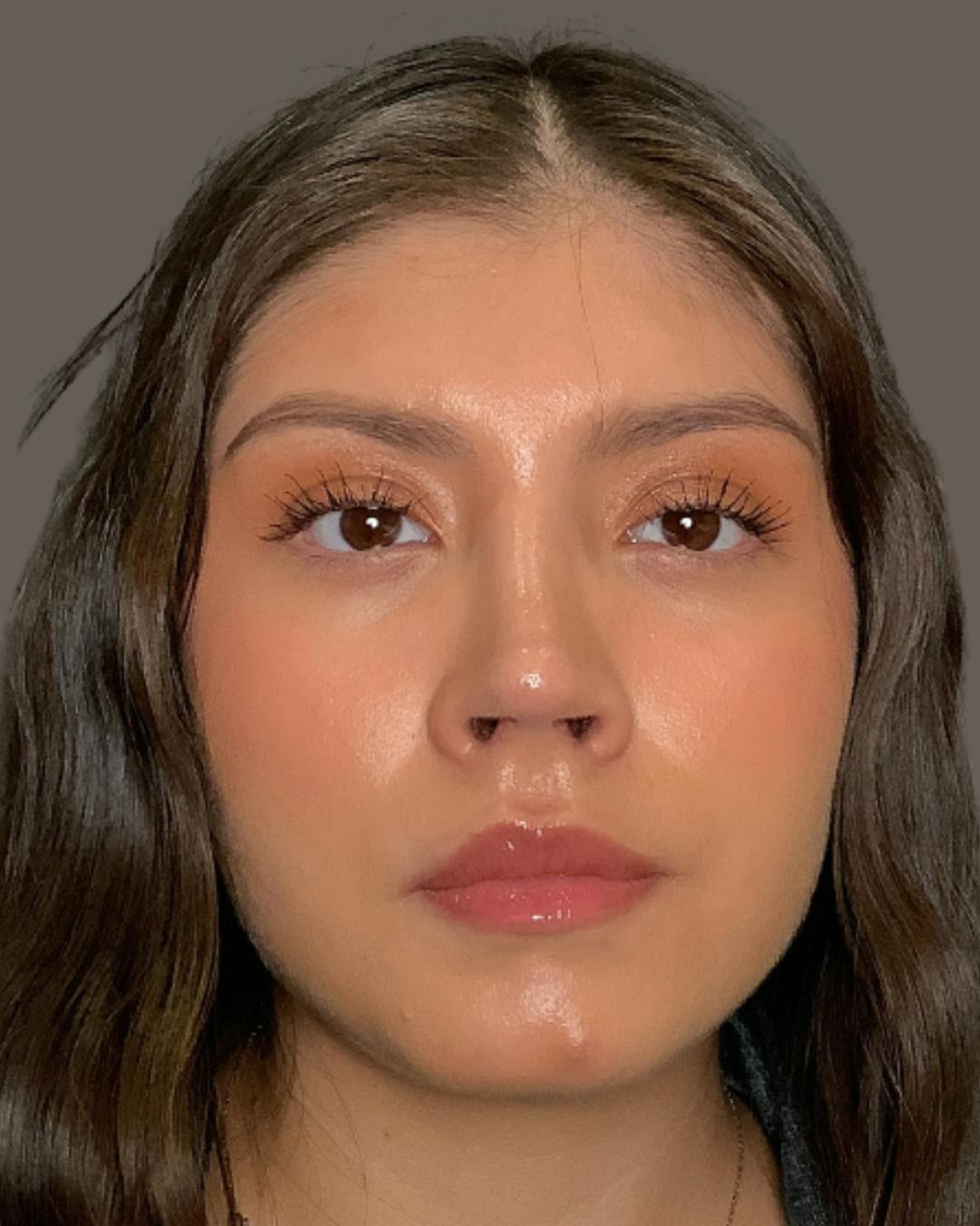 Rhinoplasty Before & After Gallery - Patient 127898 - Image 6