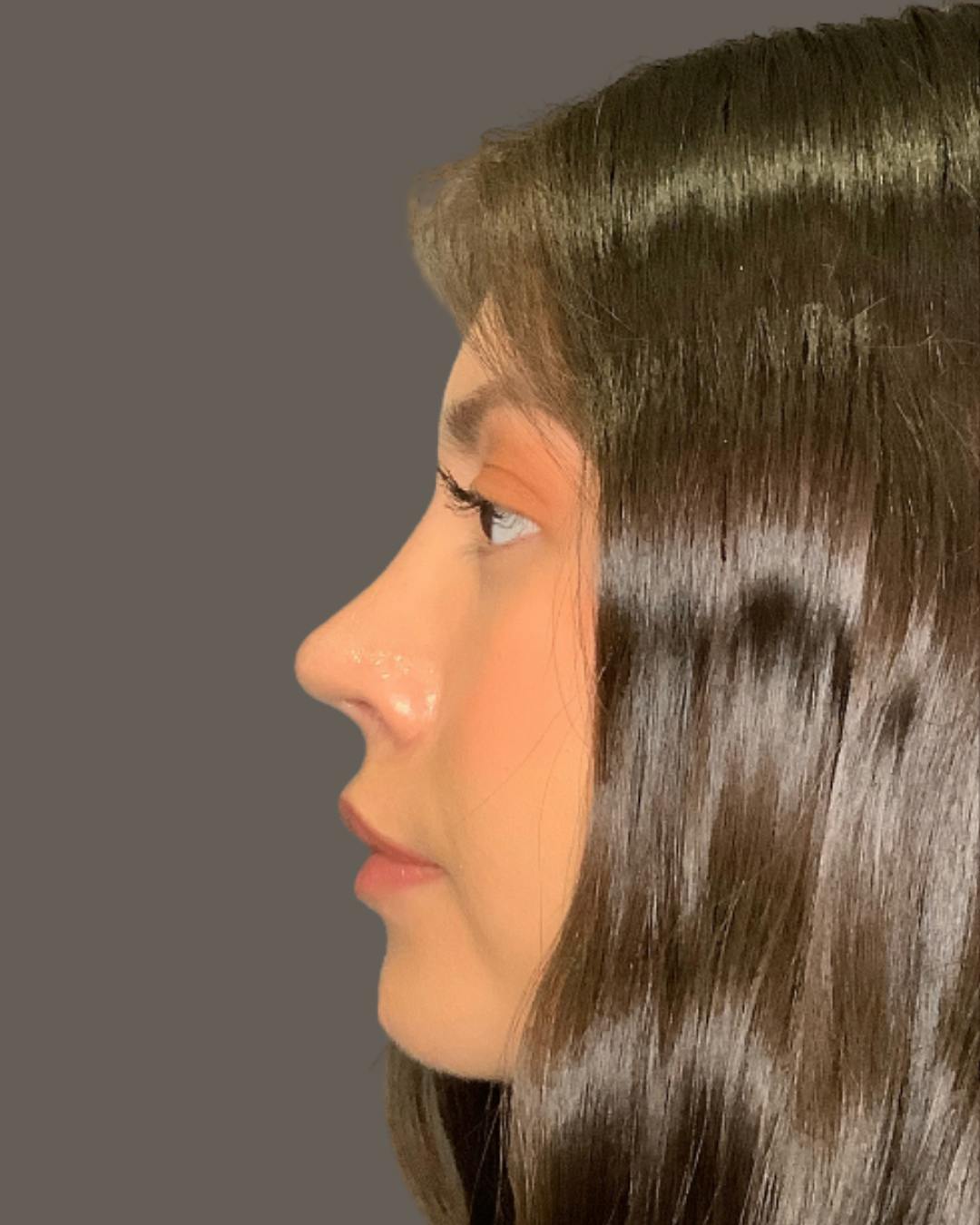 Rhinoplasty Before & After Gallery - Patient 127898 - Image 8