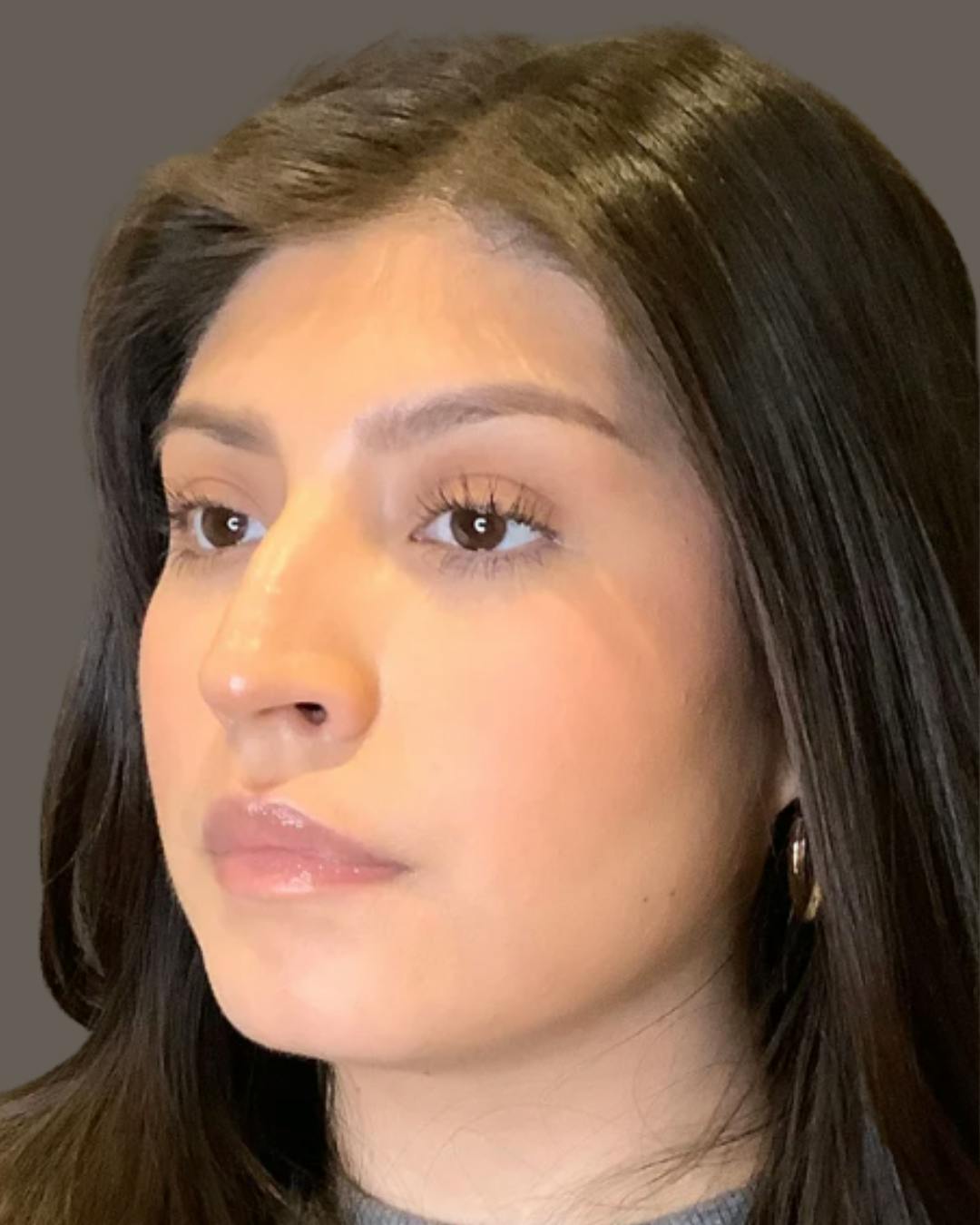 Rhinoplasty Before & After Gallery - Patient 127898 - Image 9