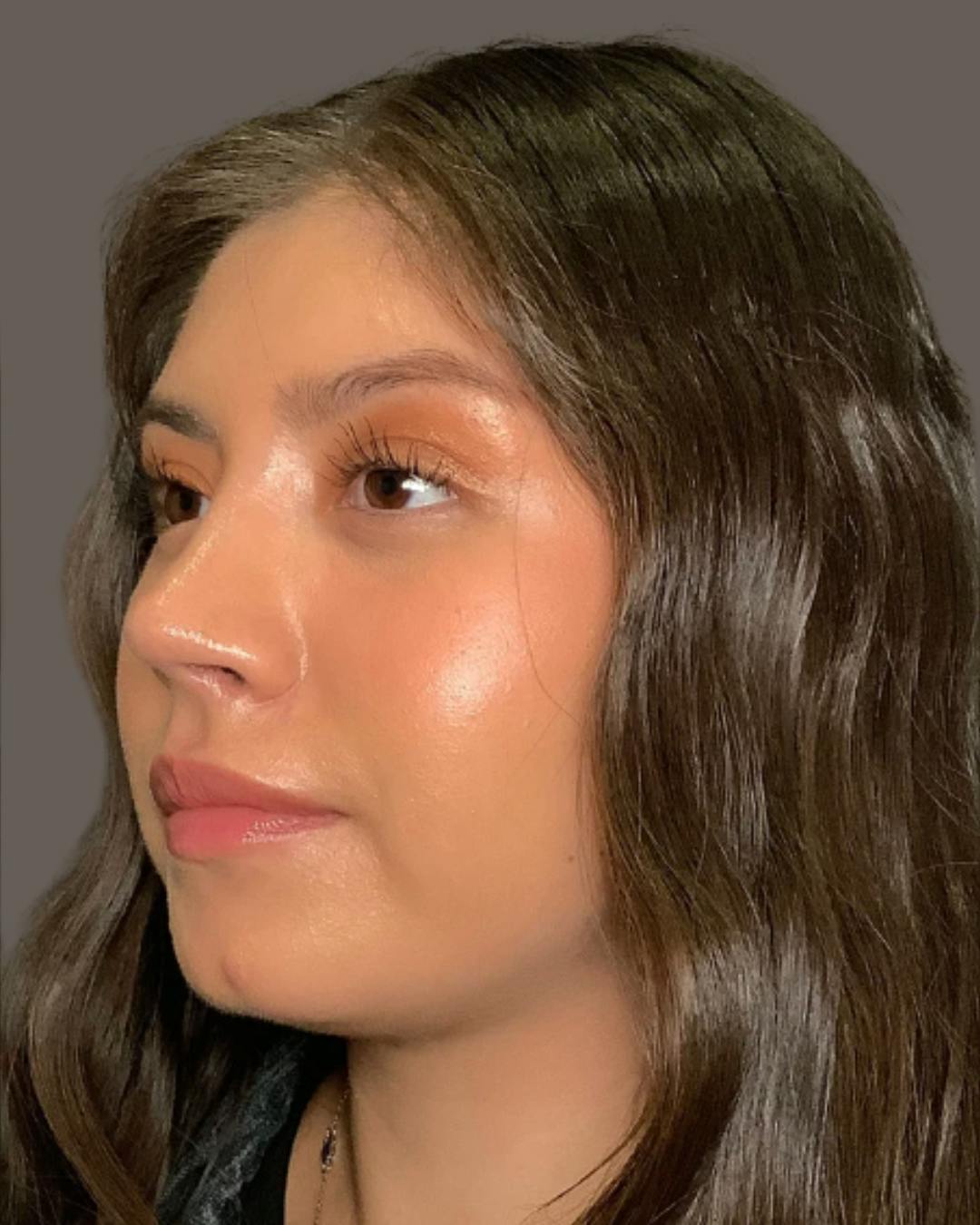 Rhinoplasty Before & After Gallery - Patient 127898 - Image 10