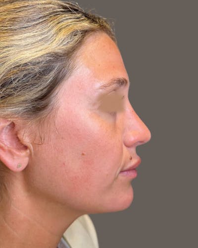 Rhinoplasty Before & After Gallery - Patient 211648 - Image 2