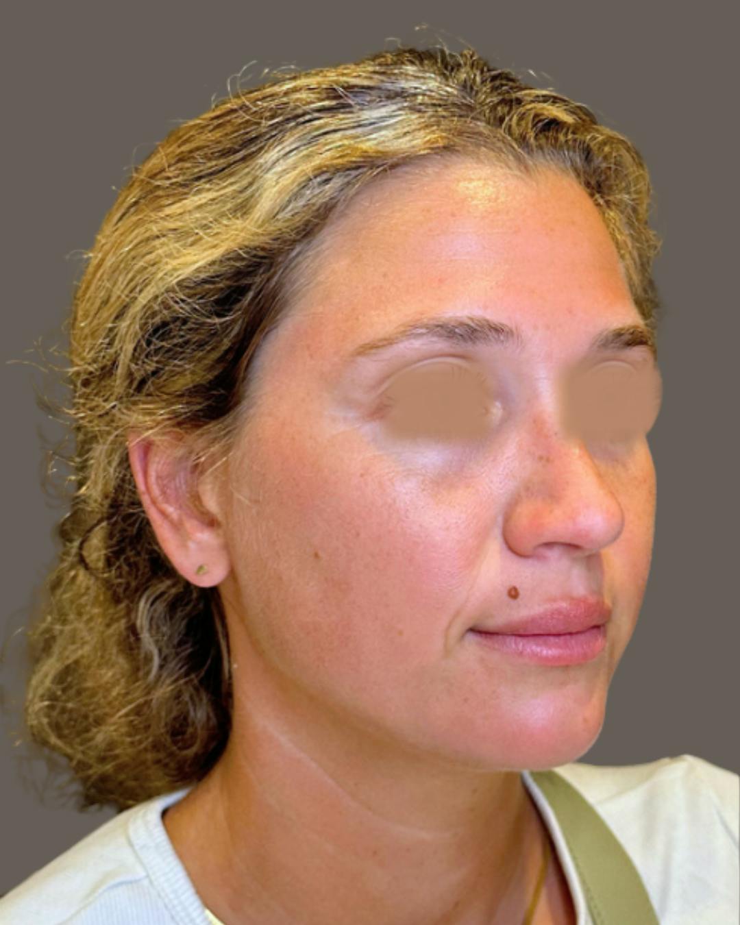 Rhinoplasty Before & After Gallery - Patient 211648 - Image 4