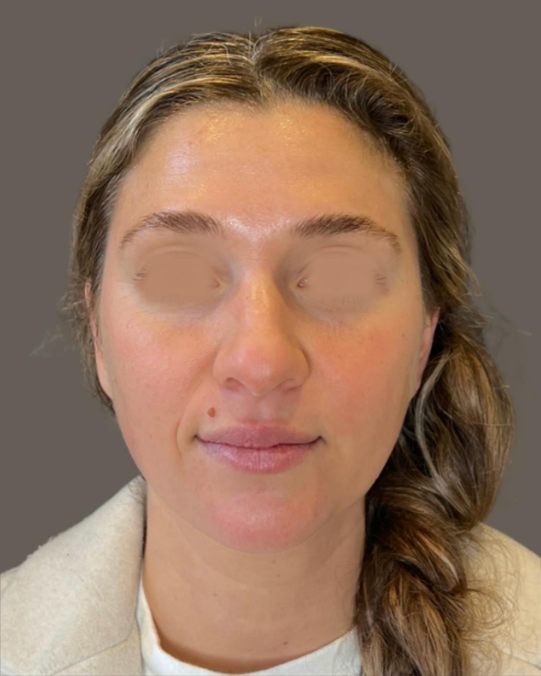 Rhinoplasty Before & After Gallery - Patient 211648 - Image 5