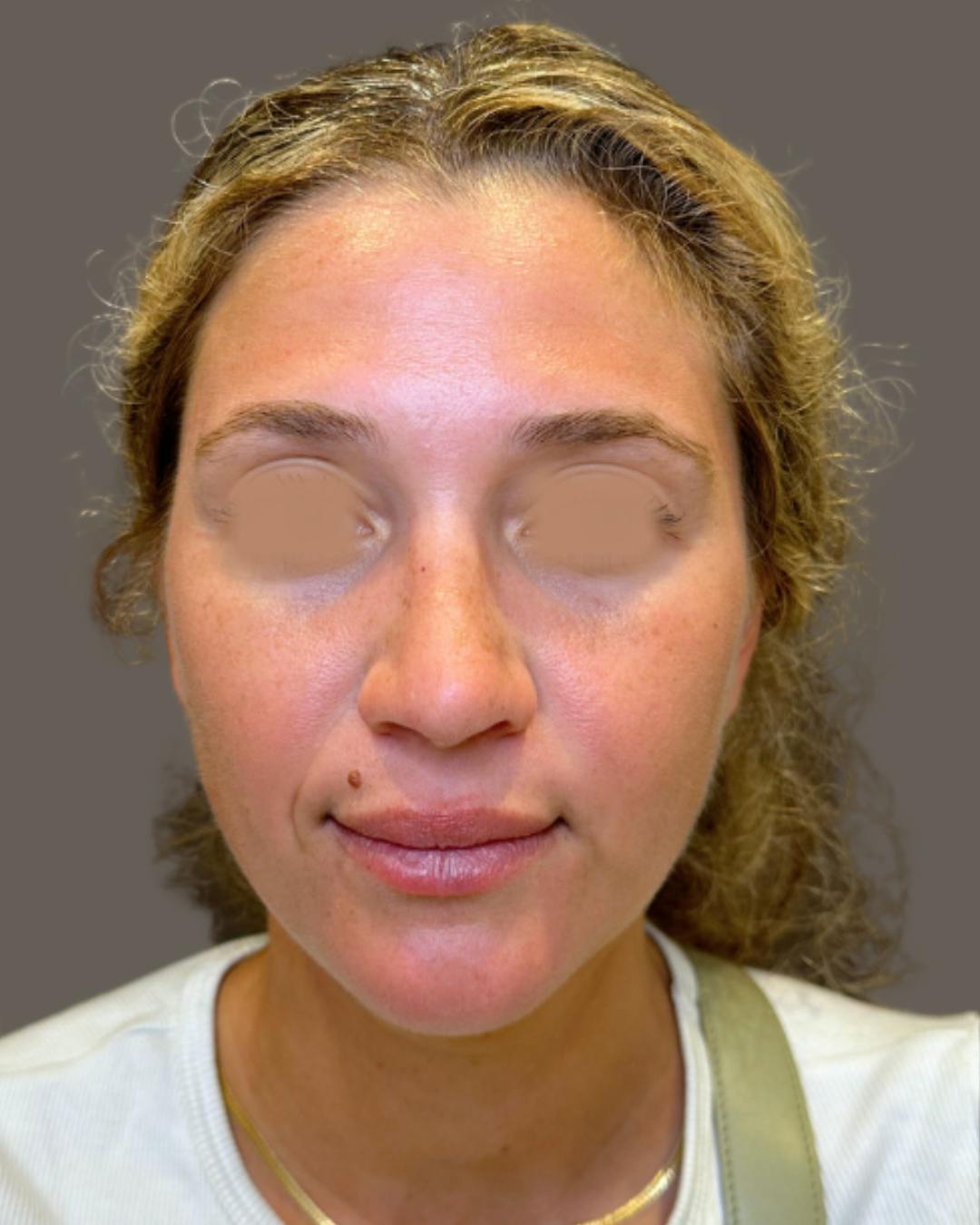 Rhinoplasty Before & After Gallery - Patient 211648 - Image 6