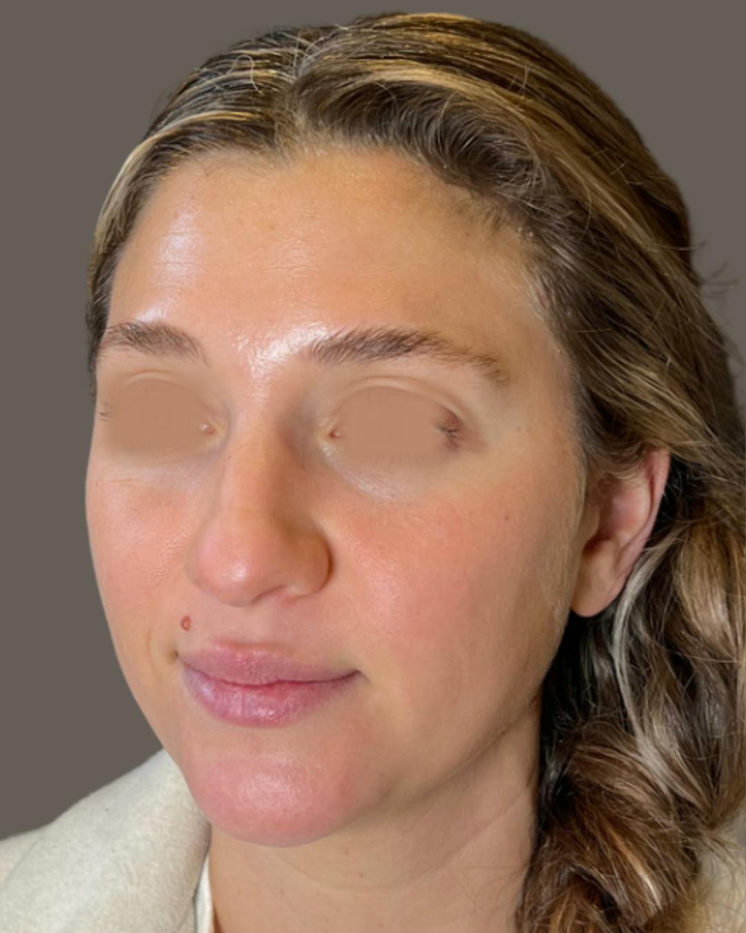 Rhinoplasty Before & After Gallery - Patient 211648 - Image 7