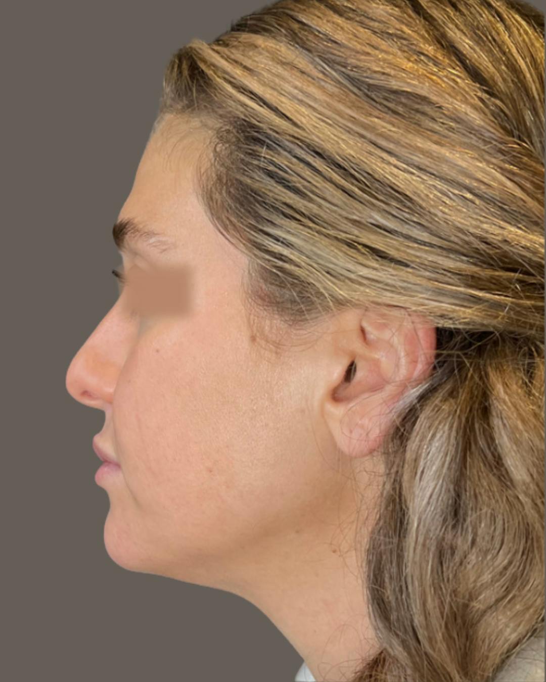 Rhinoplasty Before & After Gallery - Patient 211648 - Image 9