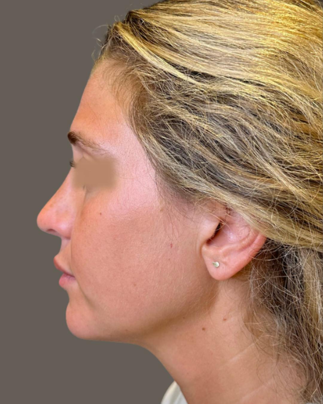 Rhinoplasty Before & After Gallery - Patient 211648 - Image 10
