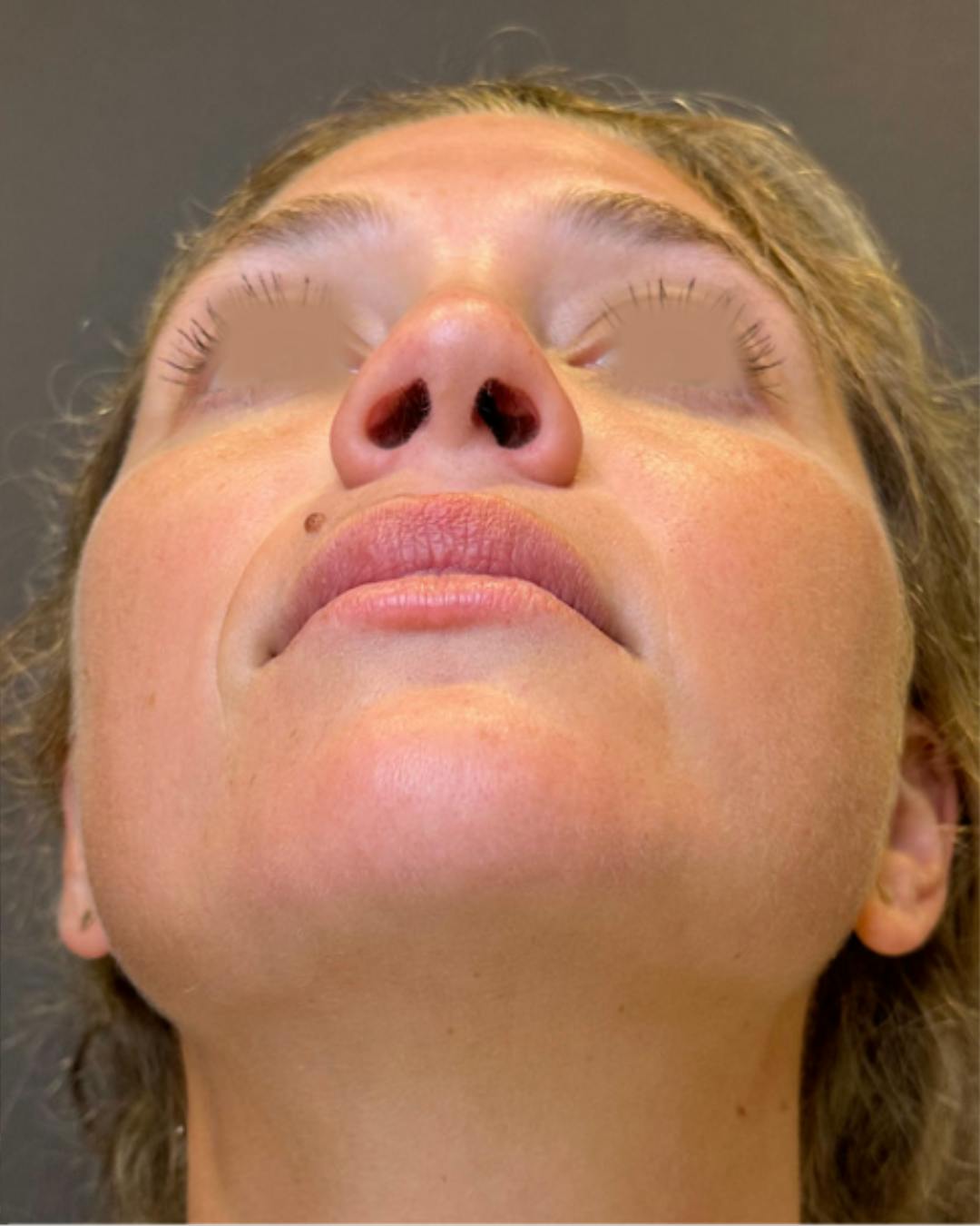 Rhinoplasty Before & After Gallery - Patient 211648 - Image 12