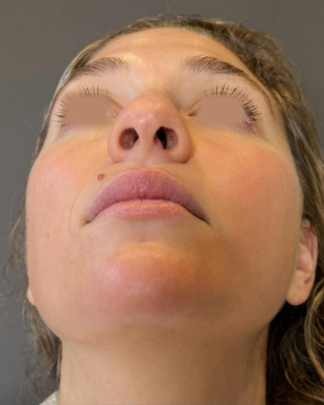 Rhinoplasty Before & After Gallery - Patient 211648 - Image 11