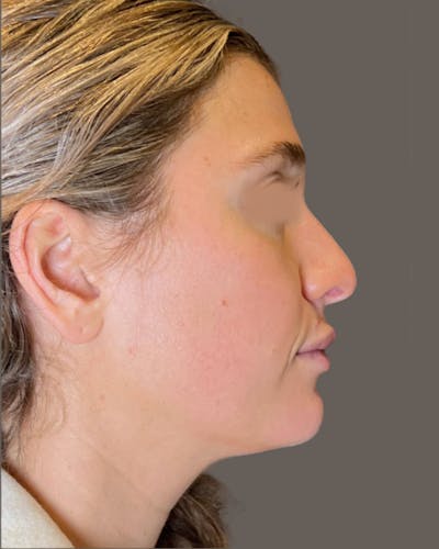 Rhinoplasty Before & After Gallery - Patient 211648 - Image 1