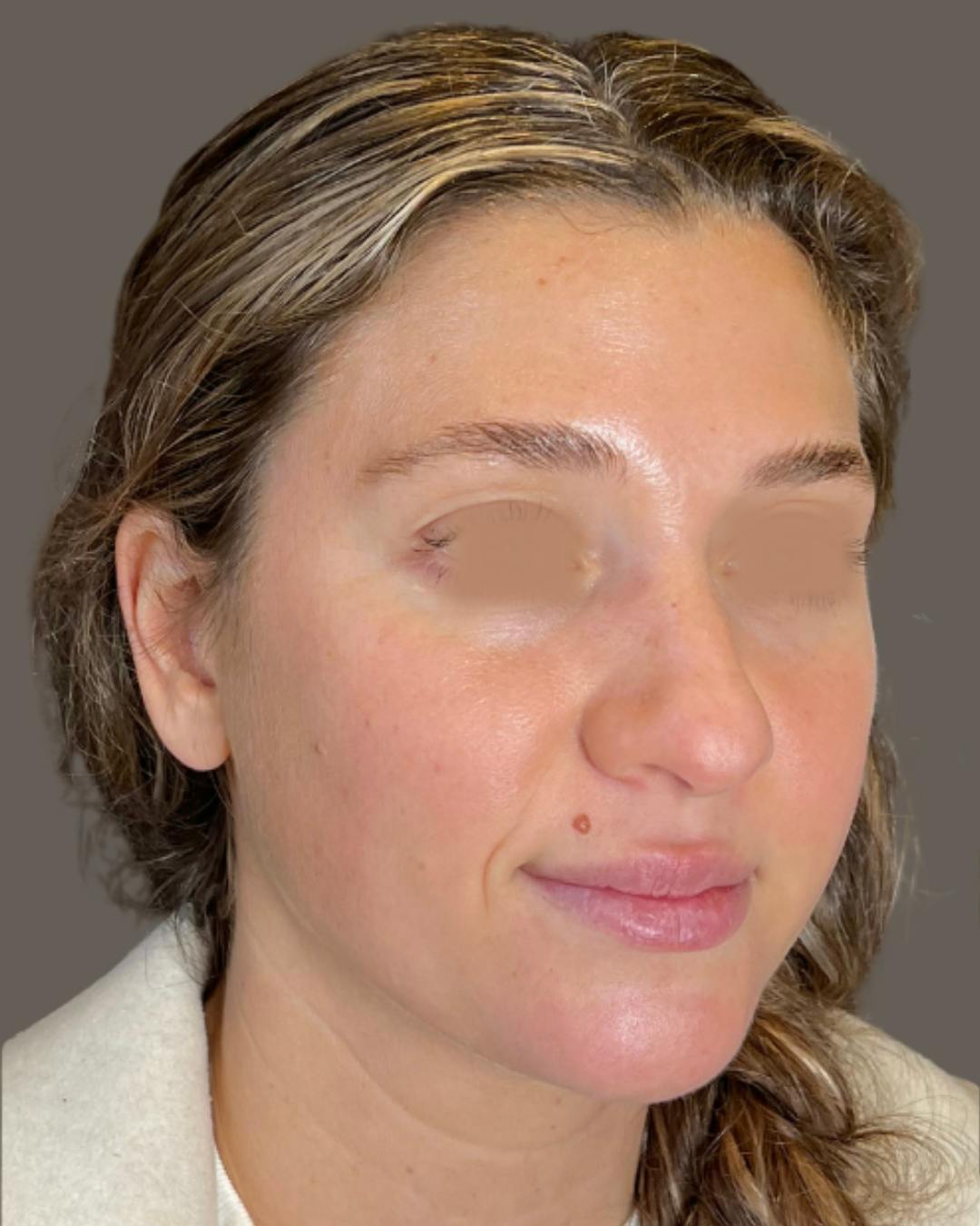 Rhinoplasty Before & After Gallery - Patient 211648 - Image 3