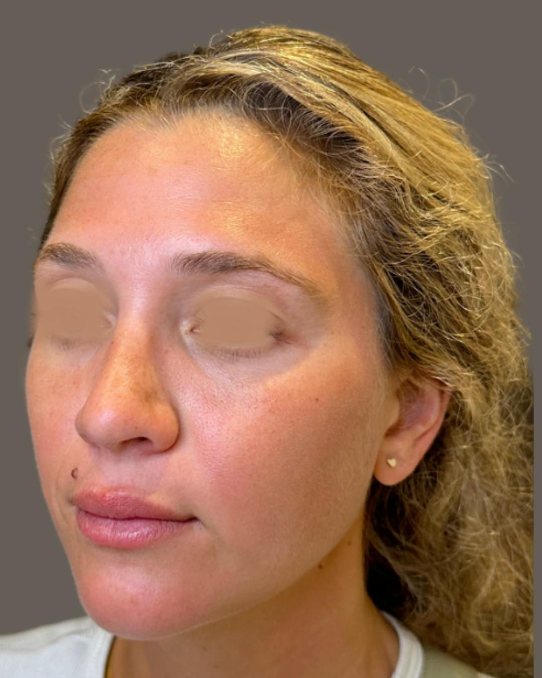 Rhinoplasty Before & After Gallery - Patient 211648 - Image 8