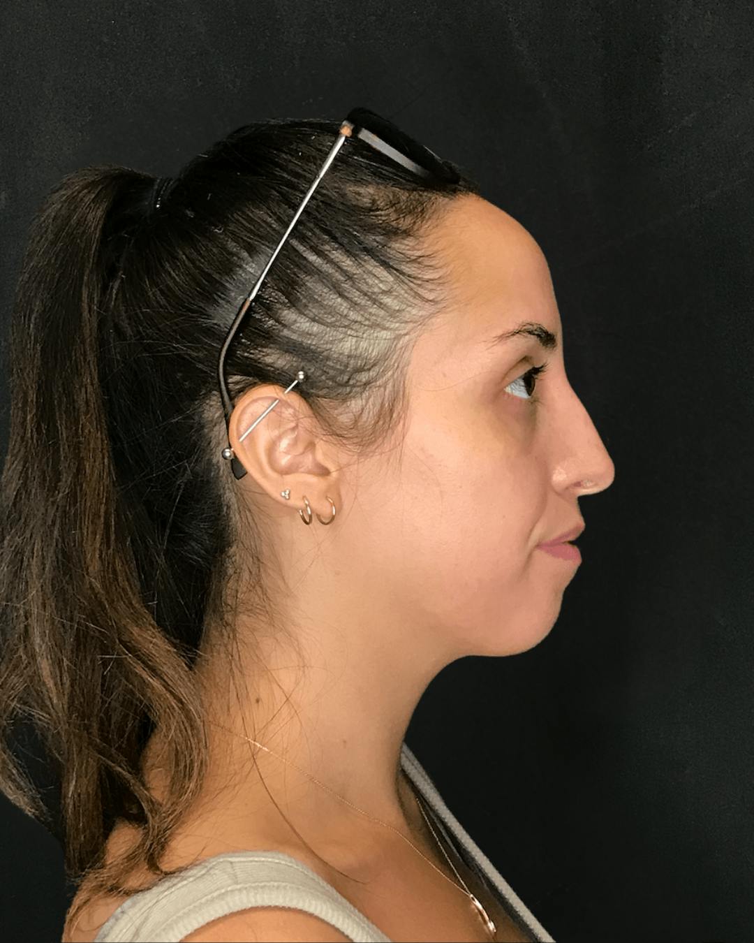 Rhinoplasty Before & After Gallery - Patient 151510785 - Image 1