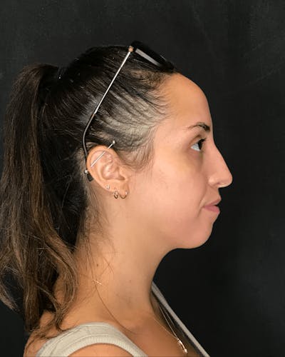 Rhinoplasty Before & After Gallery - Patient 151510785 - Image 1