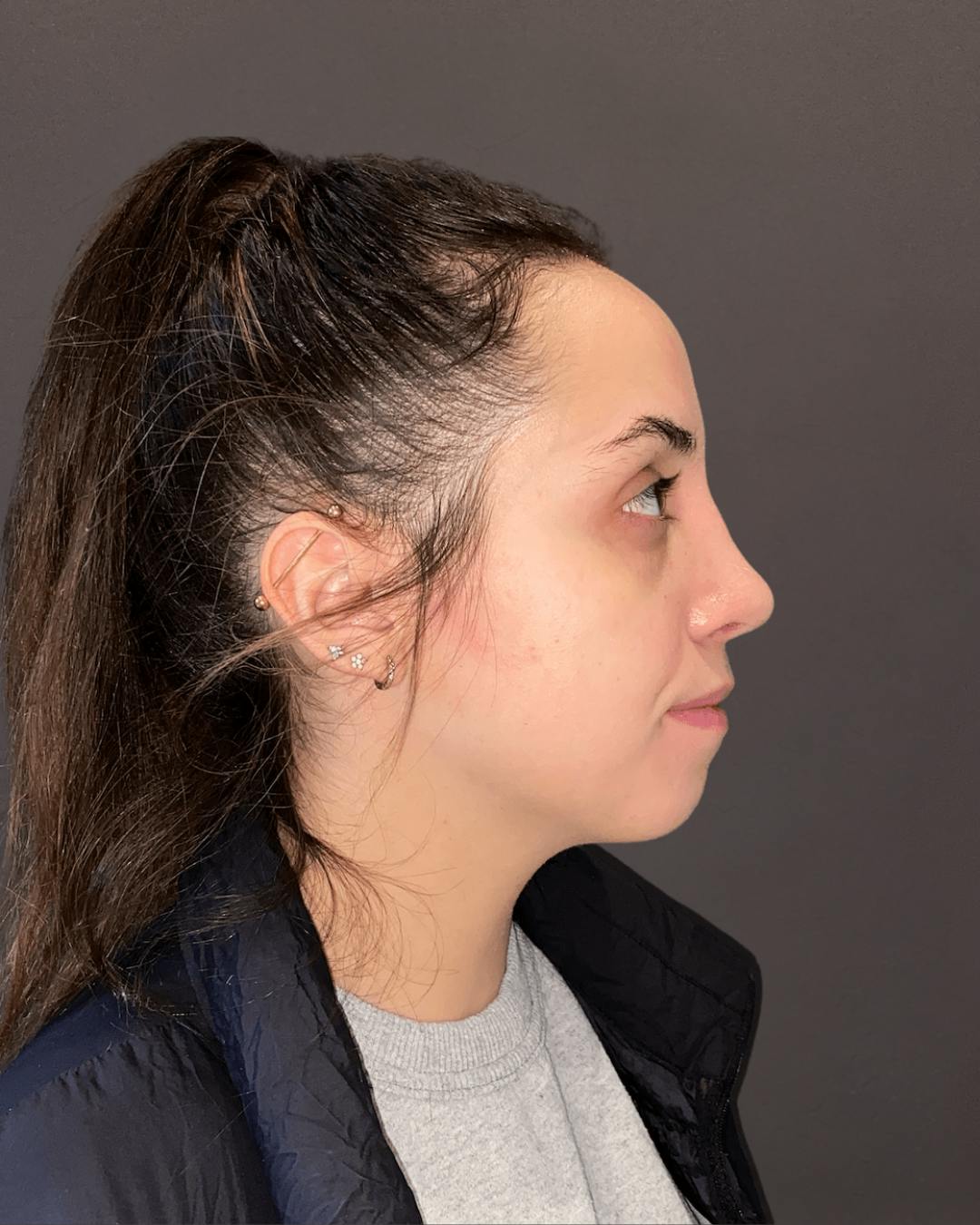 Rhinoplasty Before & After Gallery - Patient 151510785 - Image 2